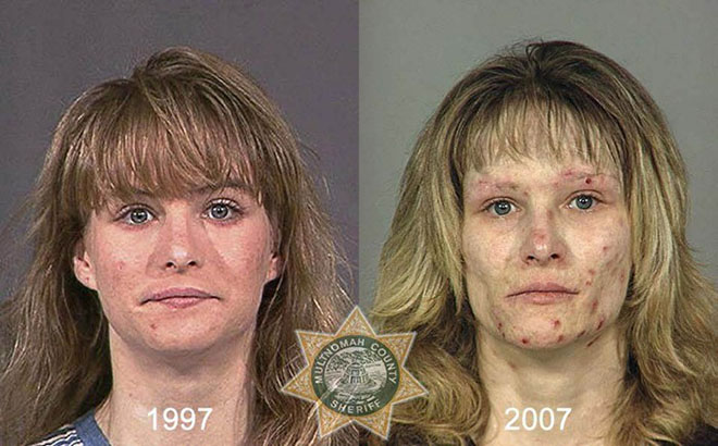 before-after-pics-drug-abusers19