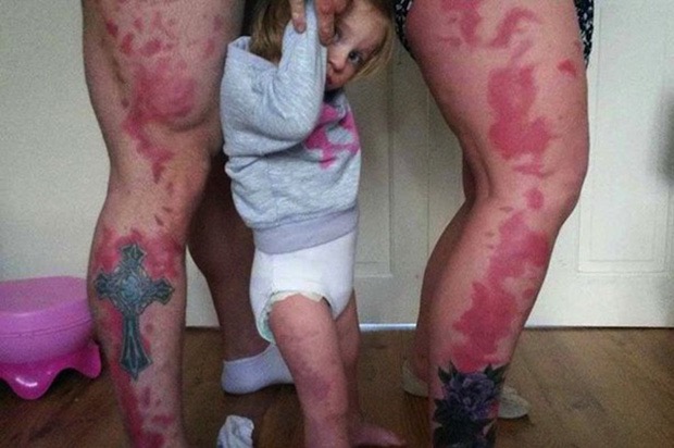 parents-got-legs-tattooed-with-daughter-birthmark-3