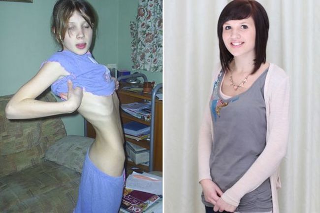 15 Ispirando prima e dopo le immagini di persone che hanno vinto la battaglia contro i loro disturbi alimentari